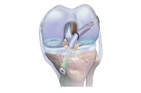 ACL Reconstruction $4500
